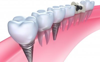 Benefits of Cosmetic Implants