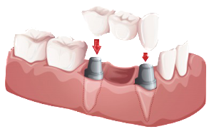 Denture Alternatives