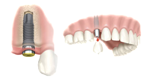 Dental Implant for People with Jawbone Loss