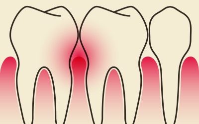 Indications of Gum Disease