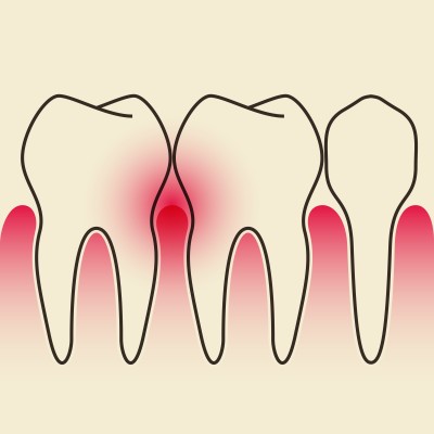 Indications of Gum Disease
