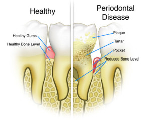 Types of Periodontal Disease
