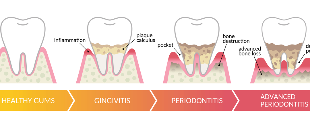 Types of Periodontal Disease