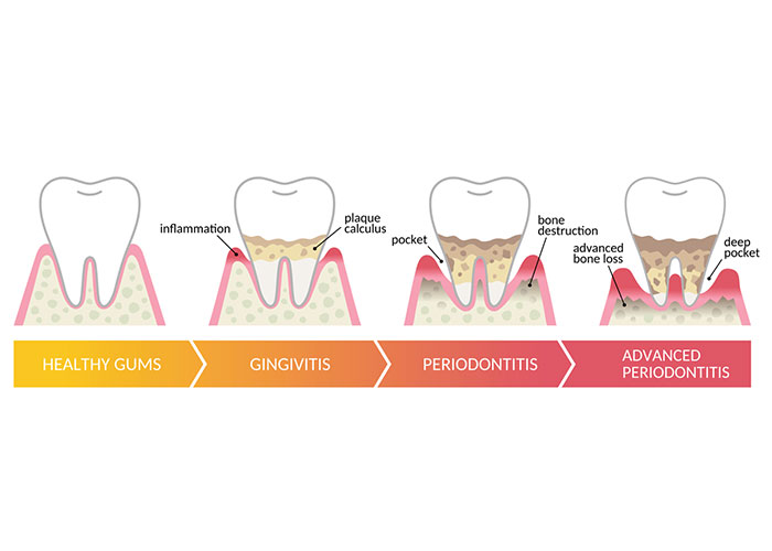 Types of Periodontal Disease